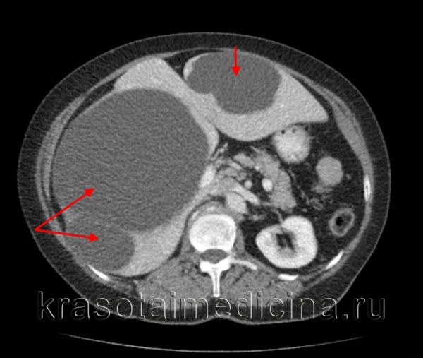 КТ органов брюшной полости. Множественные простые гигантские кисты правой и левой доли печени.