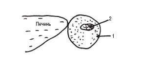 Схема: продольное сечение в эпигастрии левее средней линии (1-утолщенные стенки, 2-суженная полость желудка)