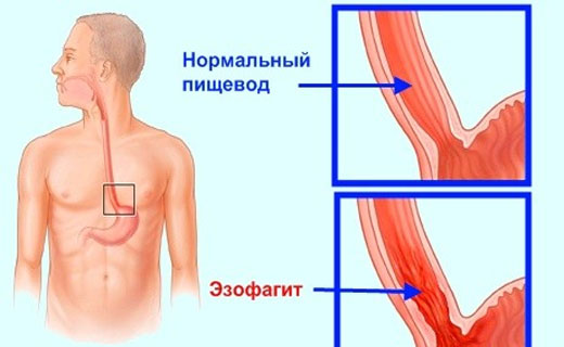  средства от рефлюкс эзофагита