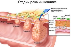 Классификация рака кишечника