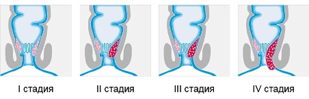 4 стадии геморроя