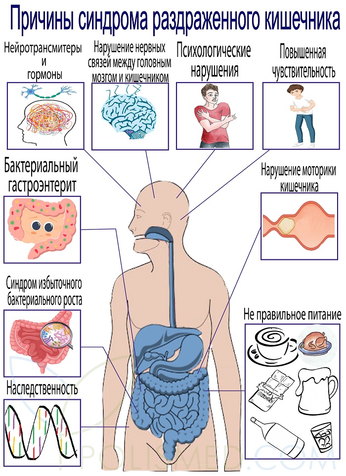 Причины синдрома раздраженного кишечника