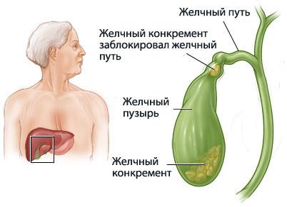 Если болит колит правый бок