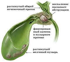 схваткообразная боль в правом подреберье