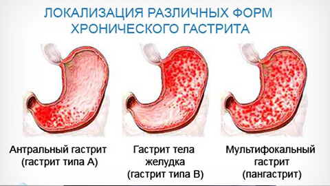 виды гастритов