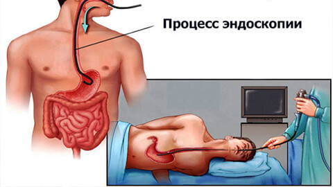 Эндоскопия желудка