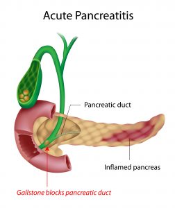 pancreatitis, gallstones, acute pancreatitis, nclex review