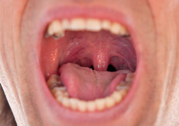 Симптомы болезни горла