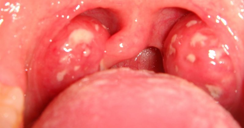 Болезнь горла ангина