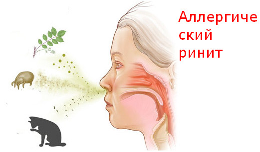 Аллергия, частая причина заложенности носа
