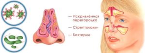 Лавровый лист при гайморите