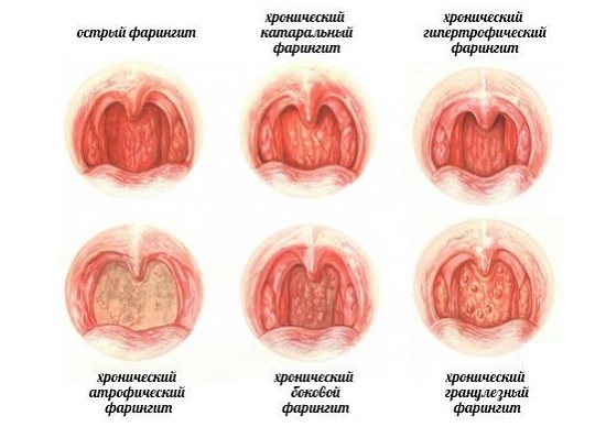 Заболевания горла и белые комочки