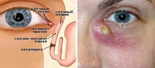 Как лечится без операции стеноз слезного канала. Что такое дакриоцистит