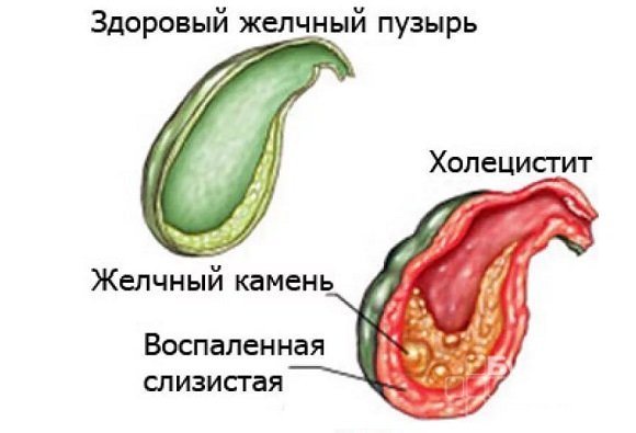 Хронический холецистит: симптомы и лечение