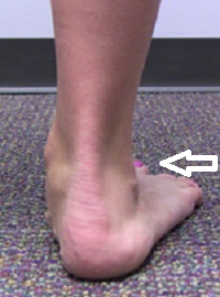 Видимость пальцев ноги, как один из основных признаков плоскостопия