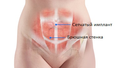 Открытая операция при пупочной грыже у женщин