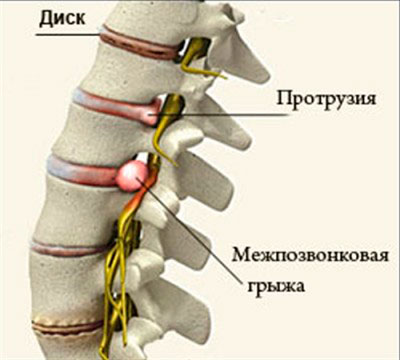 Межпозвонковая грыжа