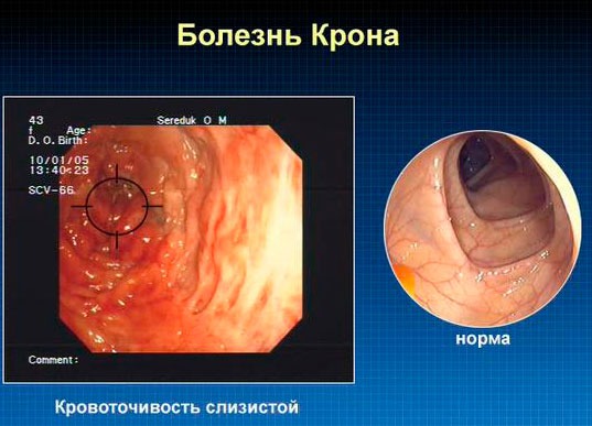 Болезнь Крона