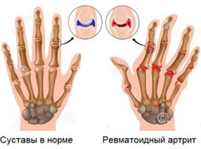 Норма и ревматоидный артрит пальцев рук