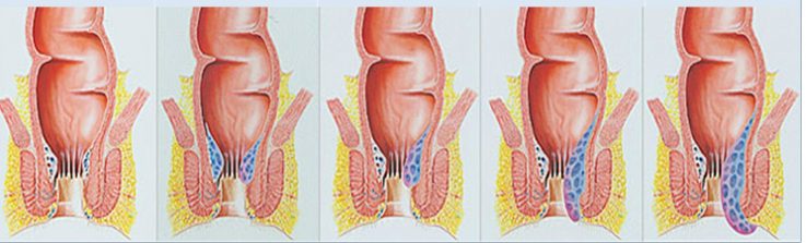 Лечение геморроя и его осложнения 