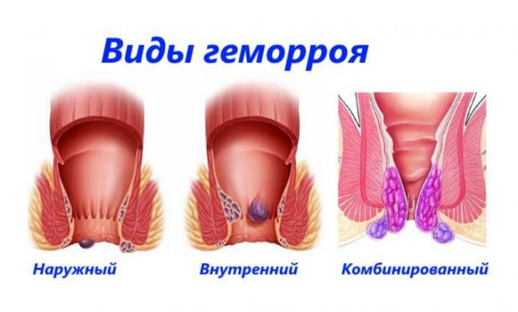 Что такое геморрой 