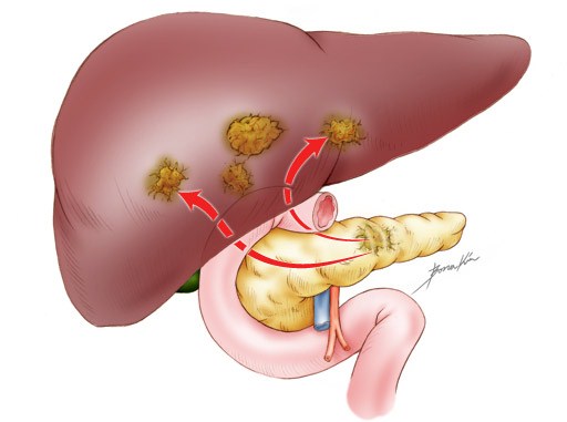  Метастазы: особенности и пути их распространения при раке печени