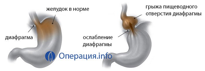 Эндоскопическая картина при грыжах пищеводного отверстия диафрагмы характеризуется