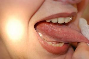 Симптоматика рака языка