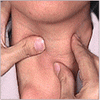 Заболевания щитовидной железы - женщины в группе риска 