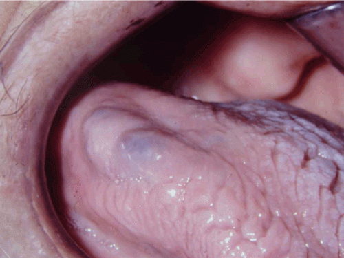 Рак языка - шишка сбоку