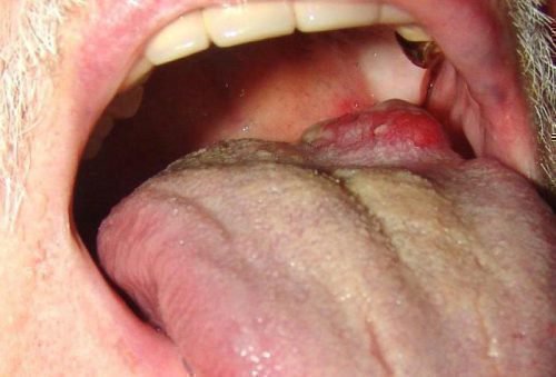 Рак языка на 3 стадии