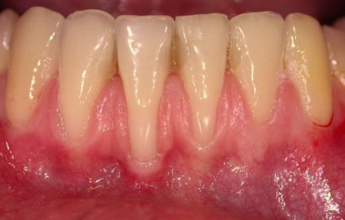 Оголение шейки зубов при пародонтозе