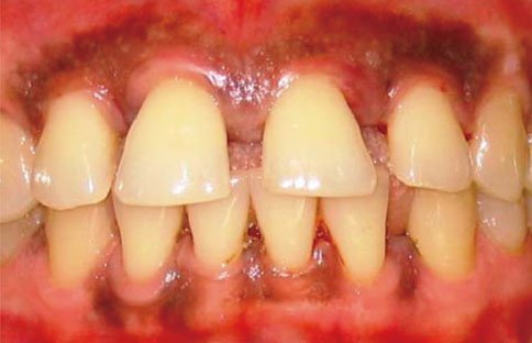 Расхождение зубов при пародонтозе у ребенка
